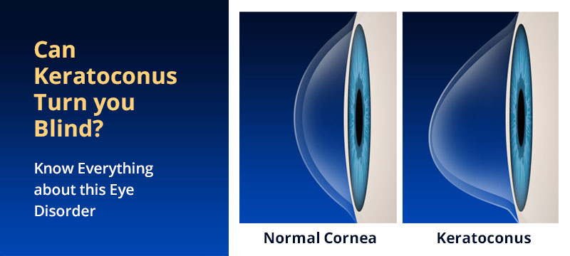 Can Keratoconus Turn you Blind? Know Everything about this Eye Disorder ...