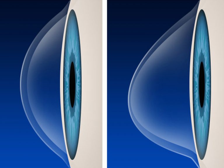 keratoconus